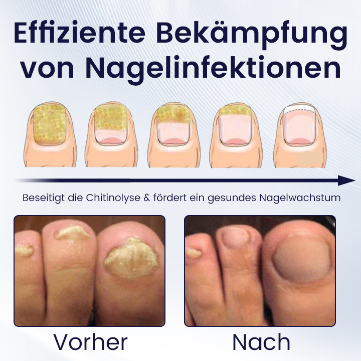 Ceoerty™ All-in-One-Nagelstärkungs-Essenzstift.
