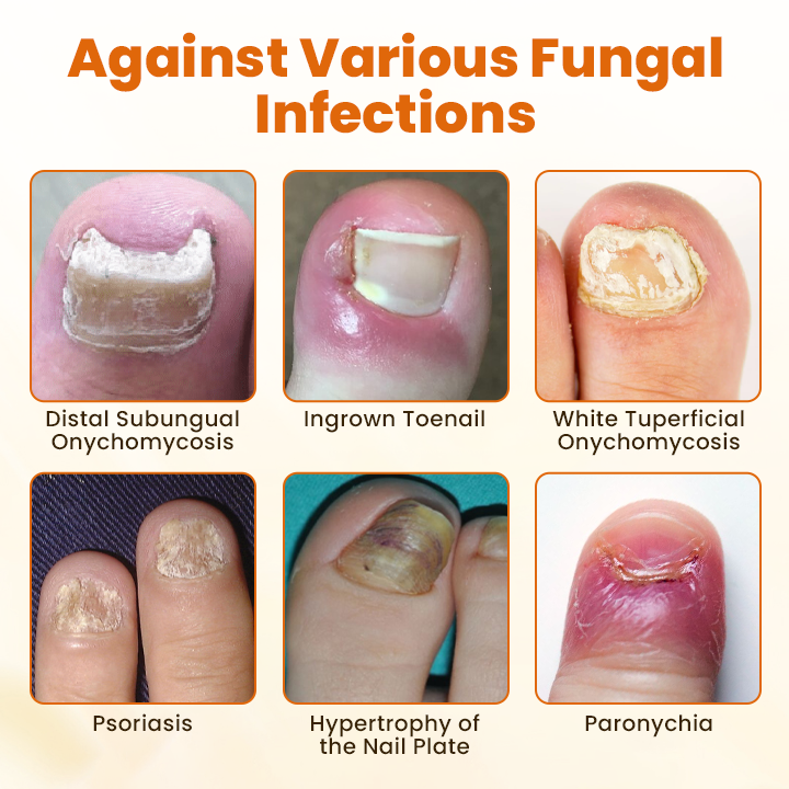 Timilk® FungiBee Fortschrittliches Nagelreparatur-Spray