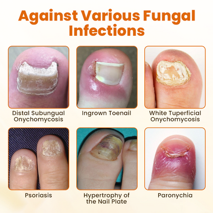 Timilk® FungiBee Fortschrittliches Nagelreparatur-Spray