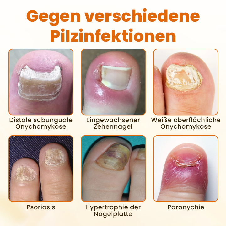 Timilk® FungiBee Fortschrittliches Nagelreparatur-Spray.