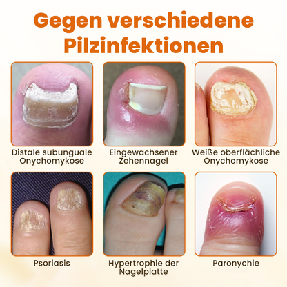 Timilk® FungiBee Fortschrittliches Nagelreparatur-Spray.