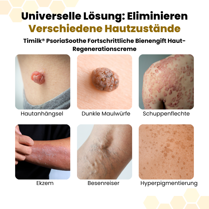 Timilk® PsoriaSoothe Fortschrittliche Bienengift Haut-Regenerationscreme.
