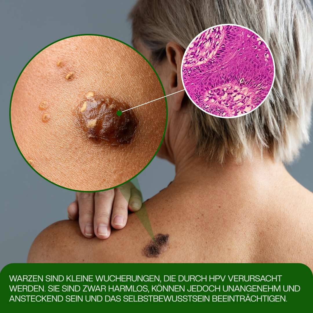 Timilk® ClinixClear Warzenentfernungs-Pflaster.