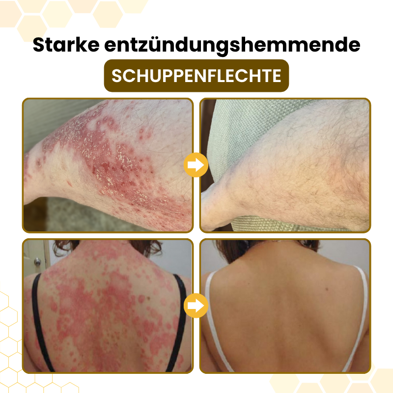 Timilk® PsoriaSoothe Fortschrittliche Bienengift Haut-Regenerationscreme.
