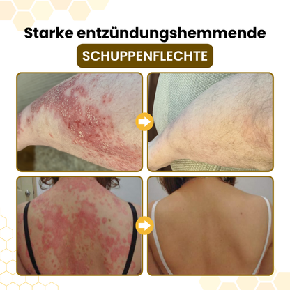Timilk® PsoriaSoothe Fortschrittliche Bienengift Haut-Regenerationscreme.