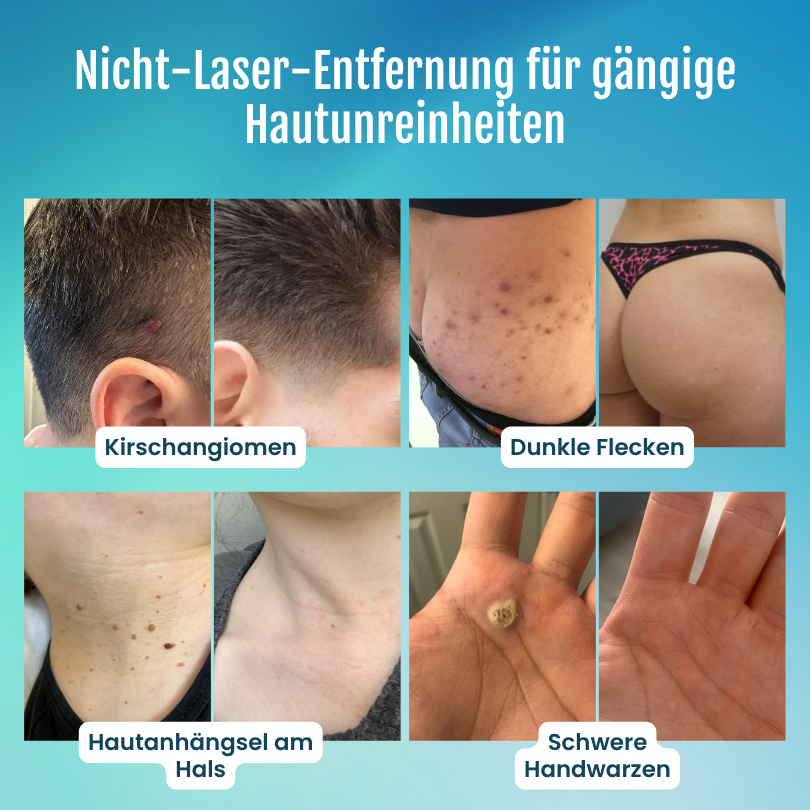 Timilk® SpotlessPro 7-Tage Fortschrittlicher Makel- & Hautanhängsel-Entferner