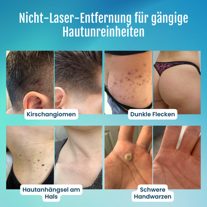 Timilk® SpotlessPro 7-Tage Fortschrittlicher Makel- & Hautanhängsel-Entferner