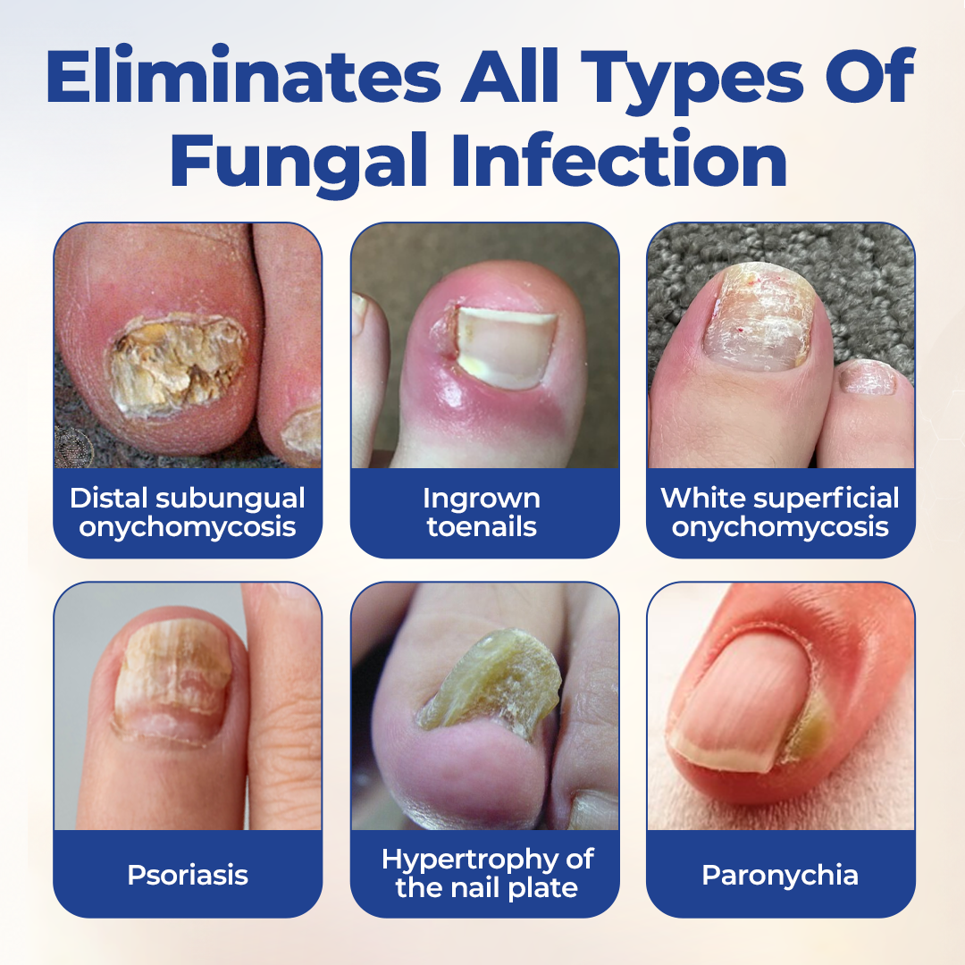 Timilk® FungiBee Fortschrittliche Nagelpflegelösung
