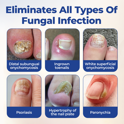 Timilk® FungiBee Fortschrittliche Nagelpflegelösung